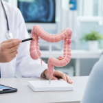 Mô hình polyp đại tràng trong tư vấn tiêu hóa