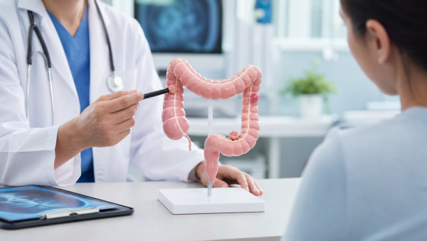 Mô hình polyp đại tràng trong tư vấn tiêu hóa